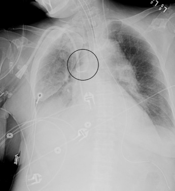 Figure 39.5, Anteroposterior chest radiograph demonstrates a left-sided central venous catheter with the tip in the azygos arch (circle). Note the straight course of the appropriately positioned right jugular split tip dialysis catheter.