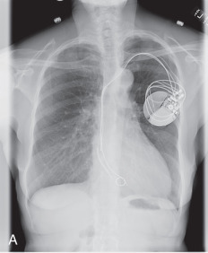 Figure 39.7, (A) Portable chest radiograph demonstrates malposition of the right ventricular (RV) lead of this automatic implantable cardioverter-defibrillator. The tip is short of the RV apex, and the wire is looped near the tricuspid valve. (B) Portable chest radiograph demonstrates an abnormally peripheral course of the RV lead. There is also a left pleural effusion. (C) Myocardial perforation is confirmed on this coronal reformatted noncontrast CT. (D) Portable chest radiograph shows a leadless pacemaker in the right ventricle. There is also a right upper lobe pulmonary nodule.