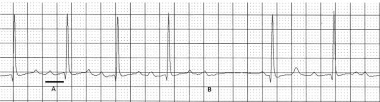 Figure 44.1, Cardiac rhythm tracing from a 17-year-old male with myotonic dystrophy that shows two types of heart block. A. First degree atrioventricular (AV) block with prolonged PR interval of 250 milliseconds (ms) indicated by solid line (normal <200 ms). B. Second degree AV block indicated by a nonconducted p wave. Both prolonged PR interval and second degree AV block are associated with an increased risk of sudden death in patients with myotonic dystrophy. 20 A pacemaker was implanted and the patient remains asymptomatic from a heart rhythm perspective.