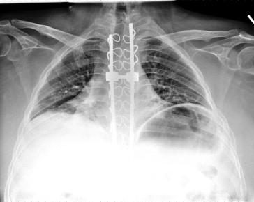 Figure 44.2, Chest X-ray from an 18-year-old male with Duchenne muscular dystrophy that demonstrates conditions placing him at increased risk of cardiopulmonary deterioration and the need for intensive cardiopulmonary support. The diaphragms are elevated with loss of air space. There is atelectasis in the right medial lung base as well as gastric distension. Orthopedic hardware is in place for spine stabilization. Cardiac size is difficult to assess with decreased lung volumes, but dysfunction was present on echocardiographic imaging. Cardiorespiratory support included night time noninvasive ventilation and medical management of heart failure.