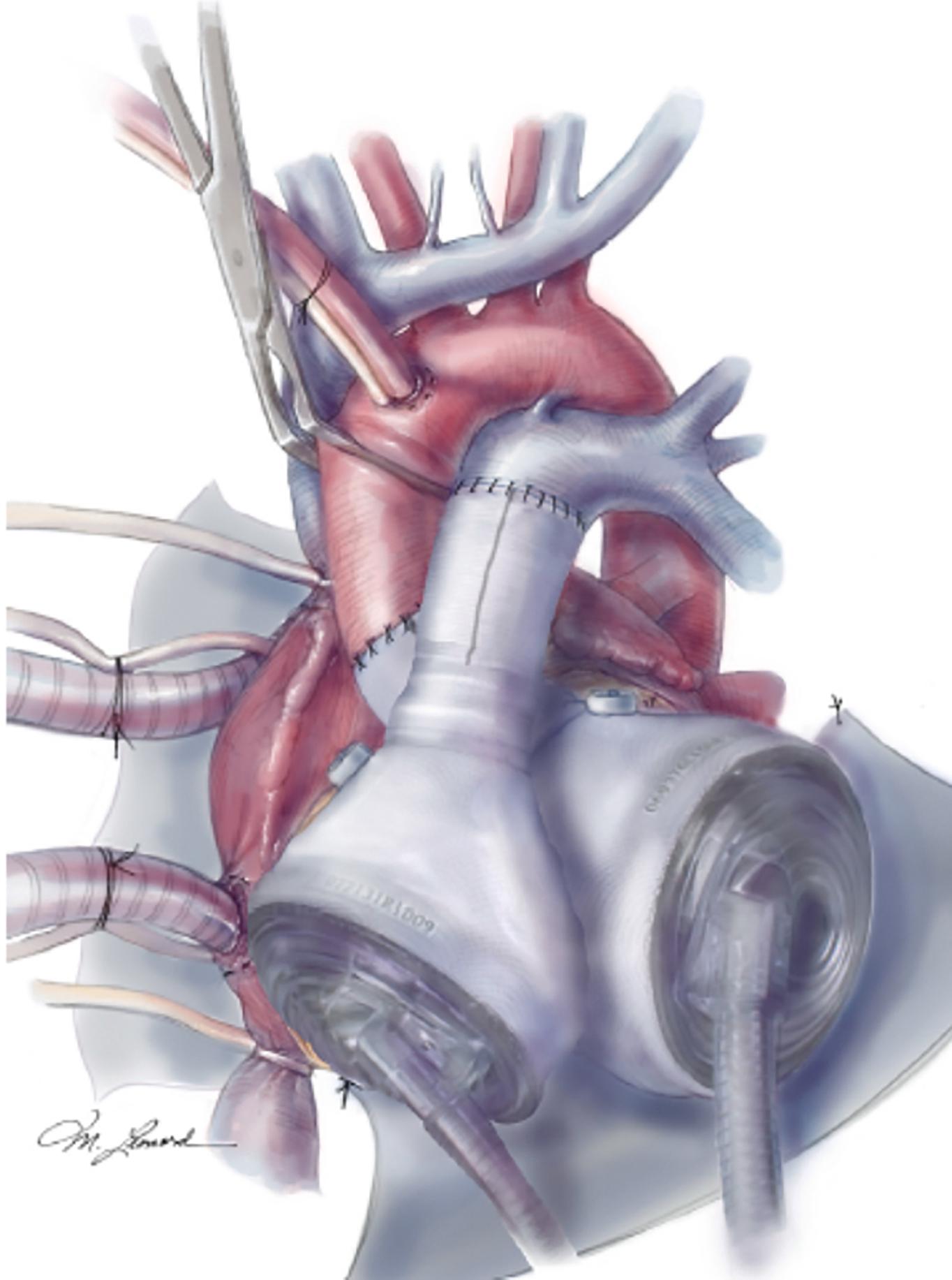 Figure 35.7, Total artificial heart device with two pneumatically driven ventricles.