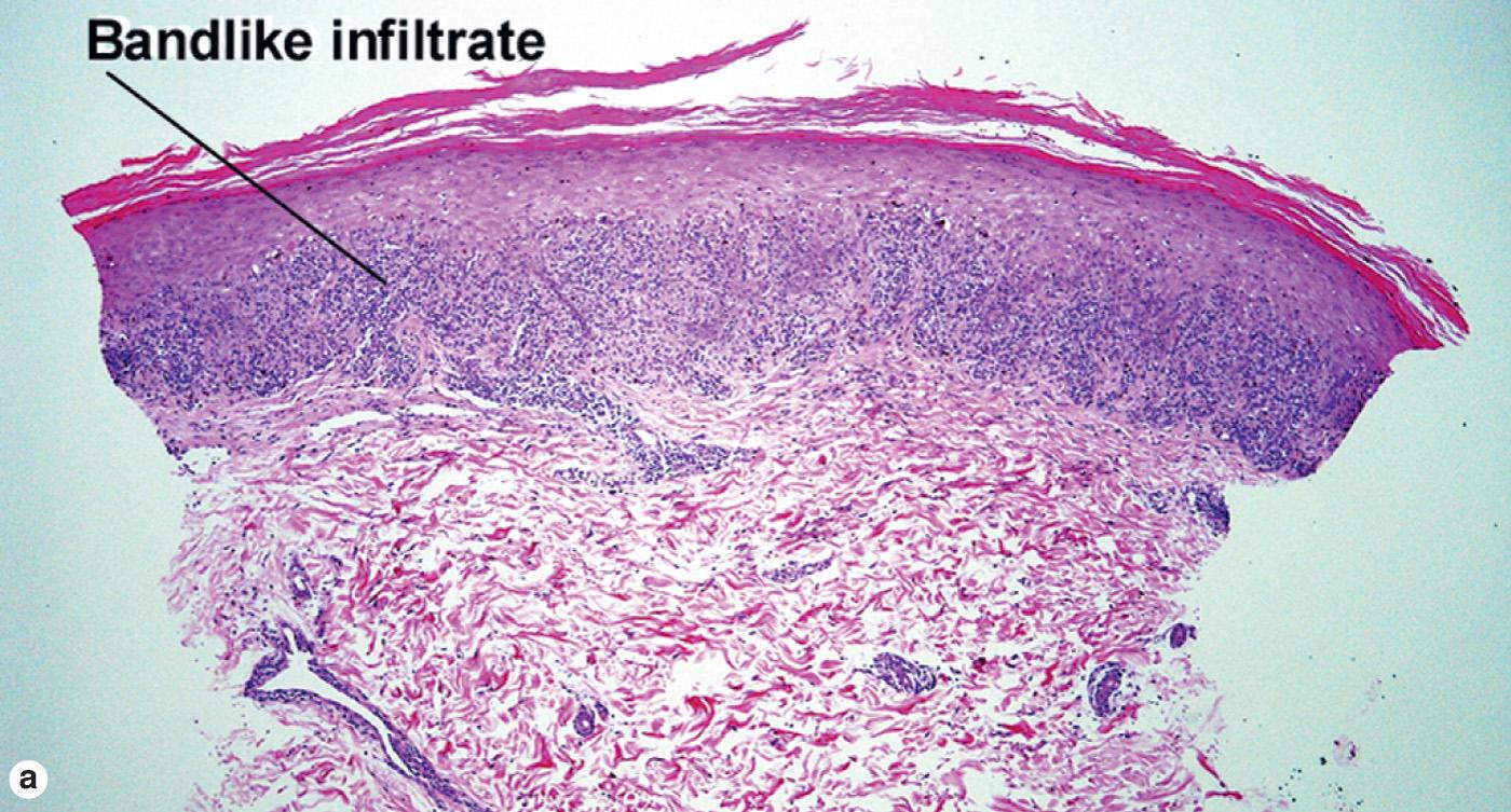 Fig. 7.2, Lichenoid interface dermatitis (lichen planus)