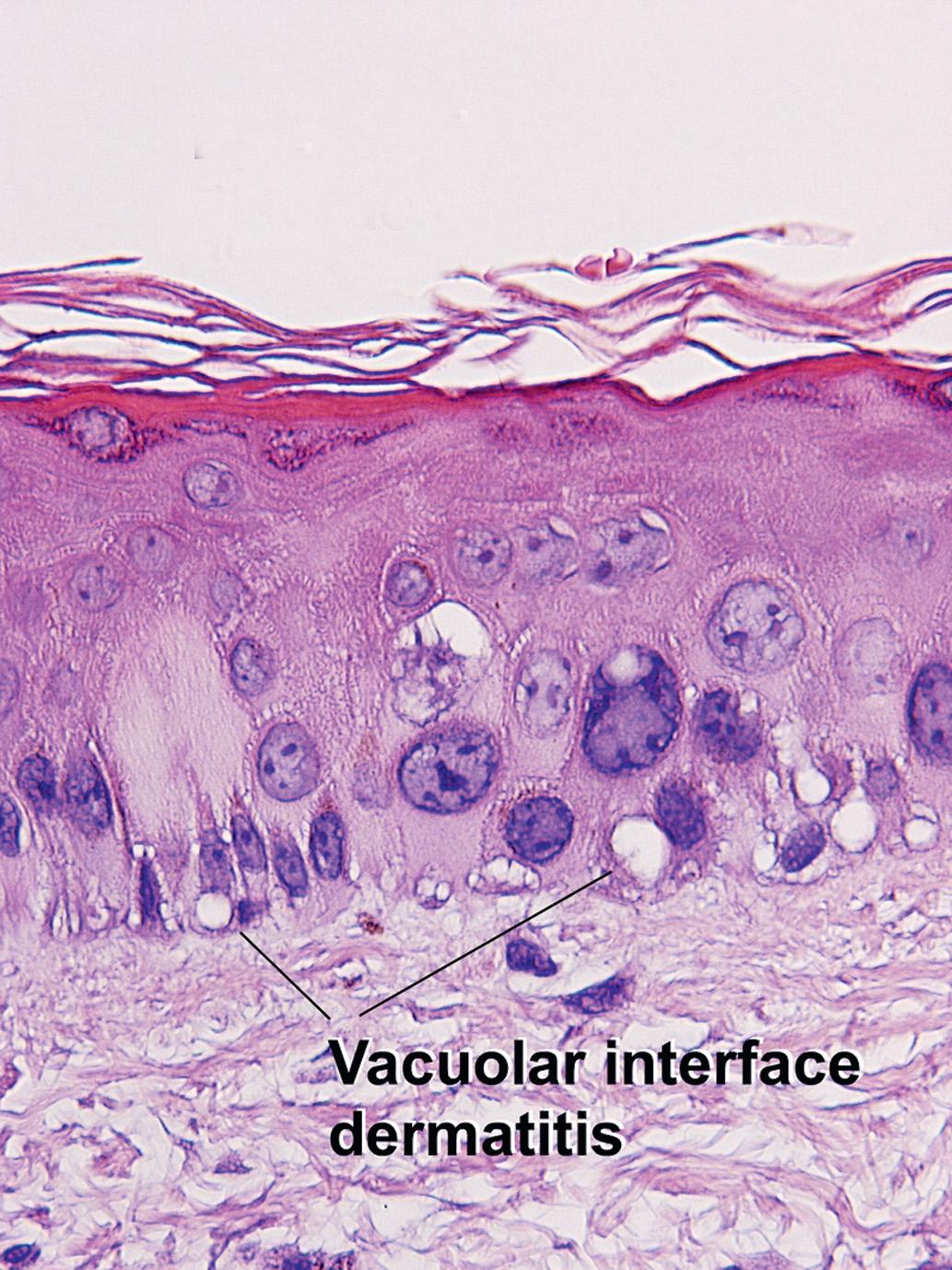 Fig. 7.3, Vacuolar interface dermatitis for comparision (graft-versus-host disease)