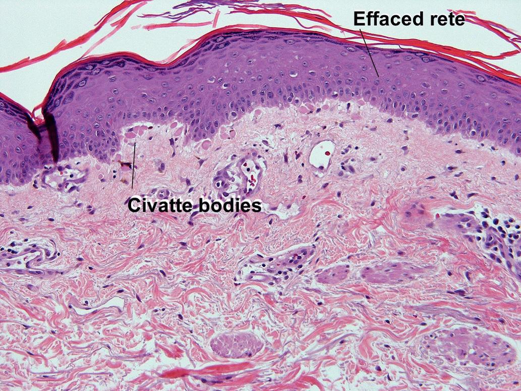 Fig. 7.4, Late-stage lichenoid dermatitis