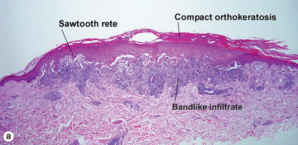 Fig. 7.5, Lichen planus