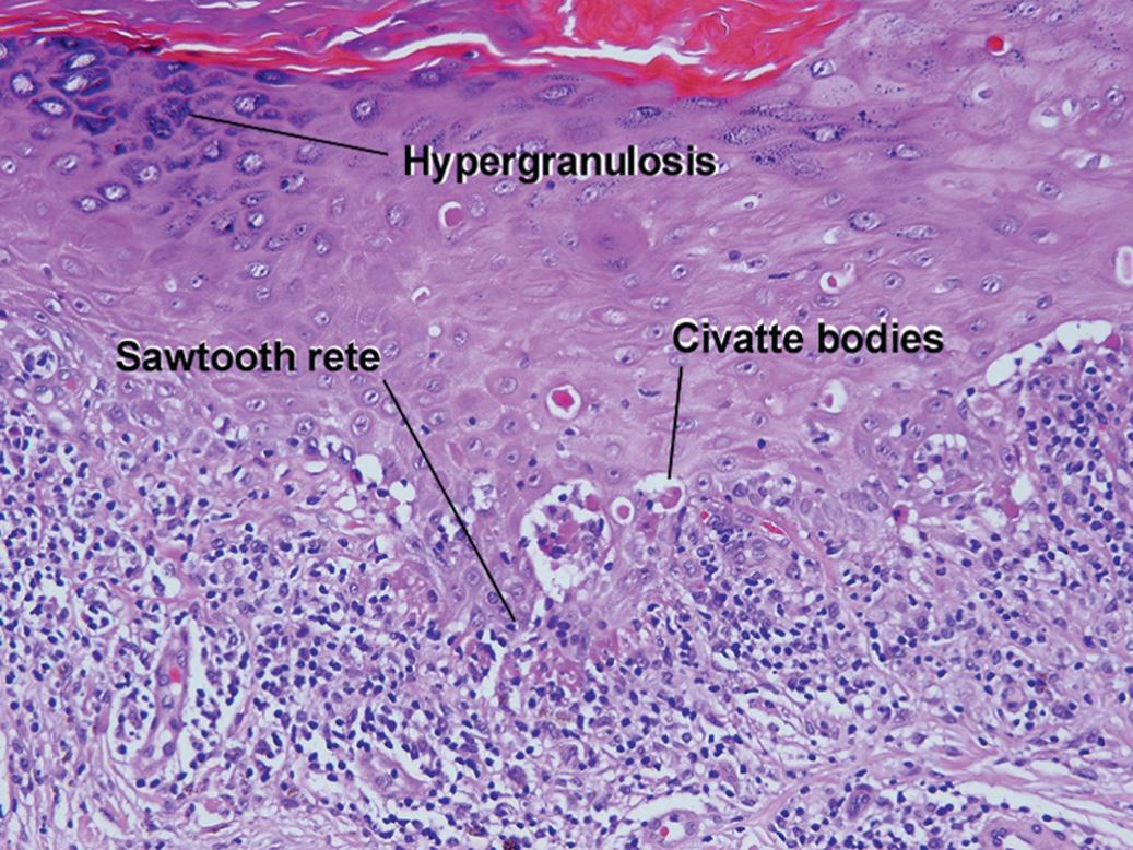 Fig. 7.7, Benign lichenoid keratosis