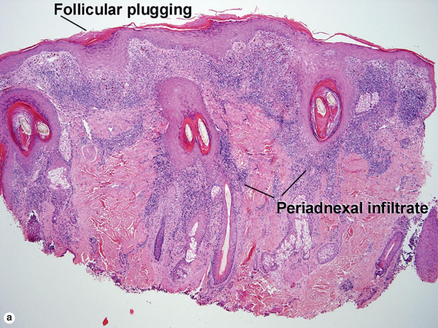 Fig. 7.9, Hypertrophic lupus erythematosus