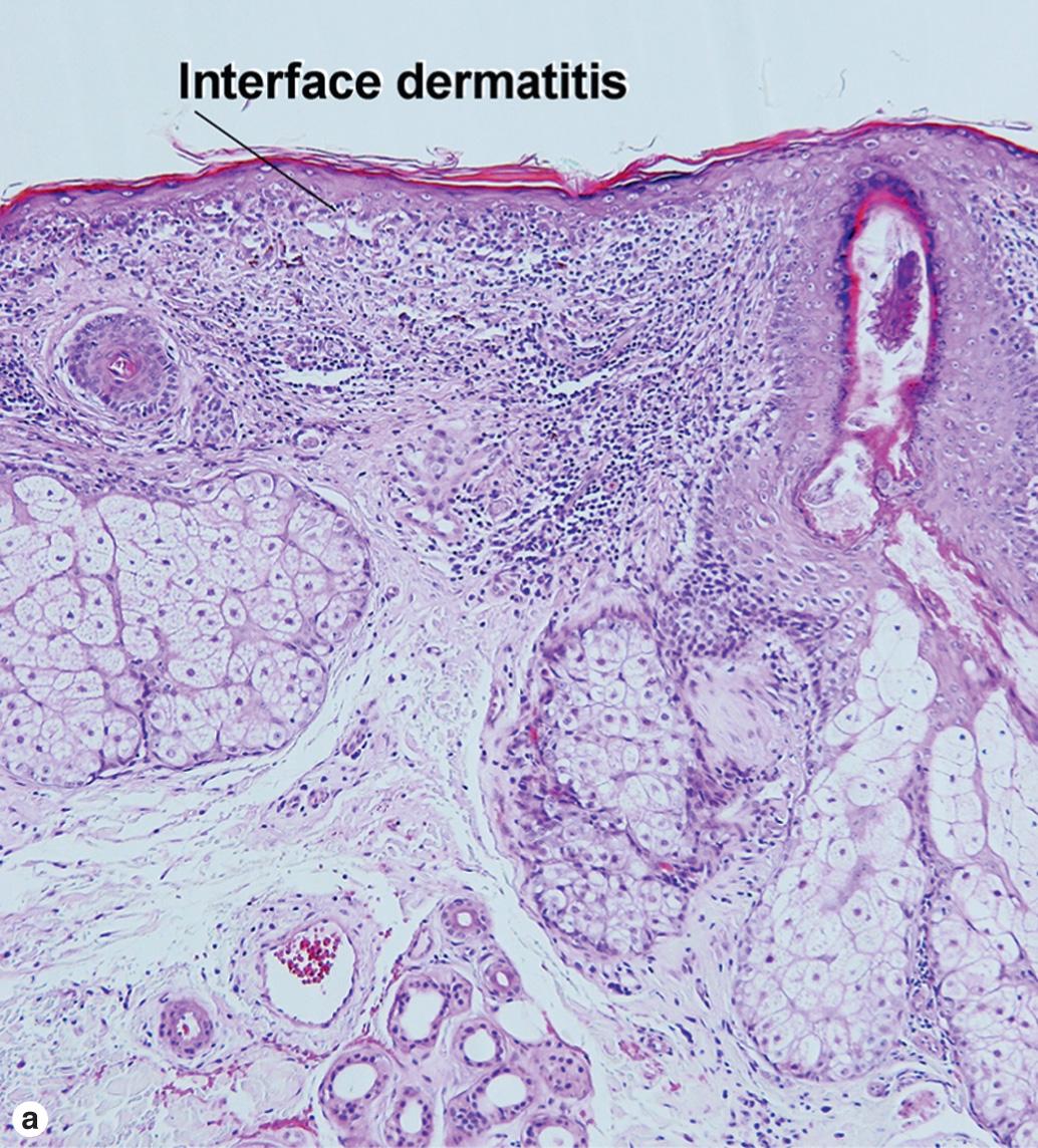 Fig. 7.10, Lichenoid regression within a lentigo maligna