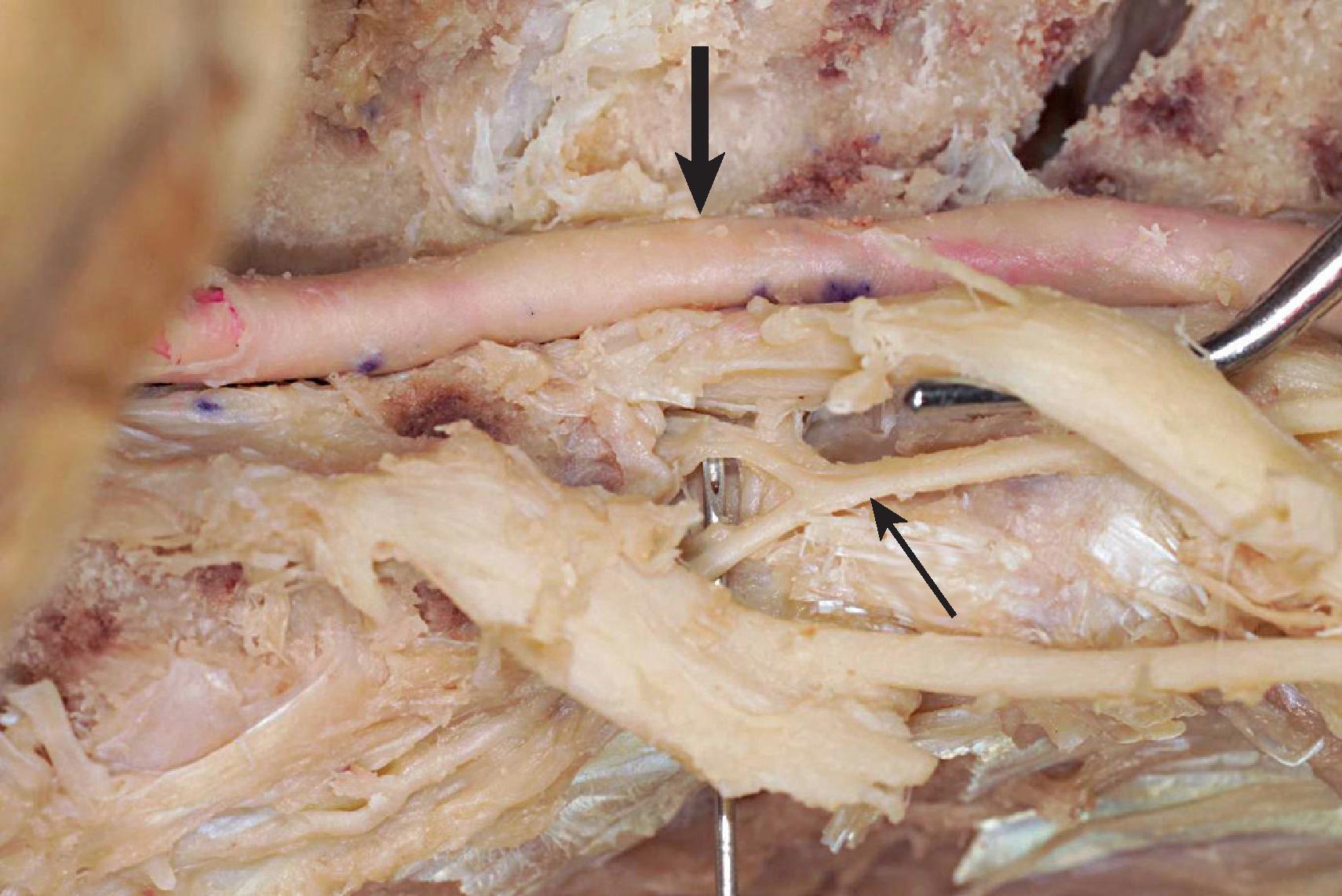 Figure 65.1, Anatomic cadaver dissection demonstrating the vertebral artery ( pink, large arrow ) and the exiting left C5 spinal nerve lifted by the probe. The needle tip is pushing on a spinal branch of the ascending cervical artery ( small arrow ) at the outer aspect of the C4-5 intervertebral foramen.