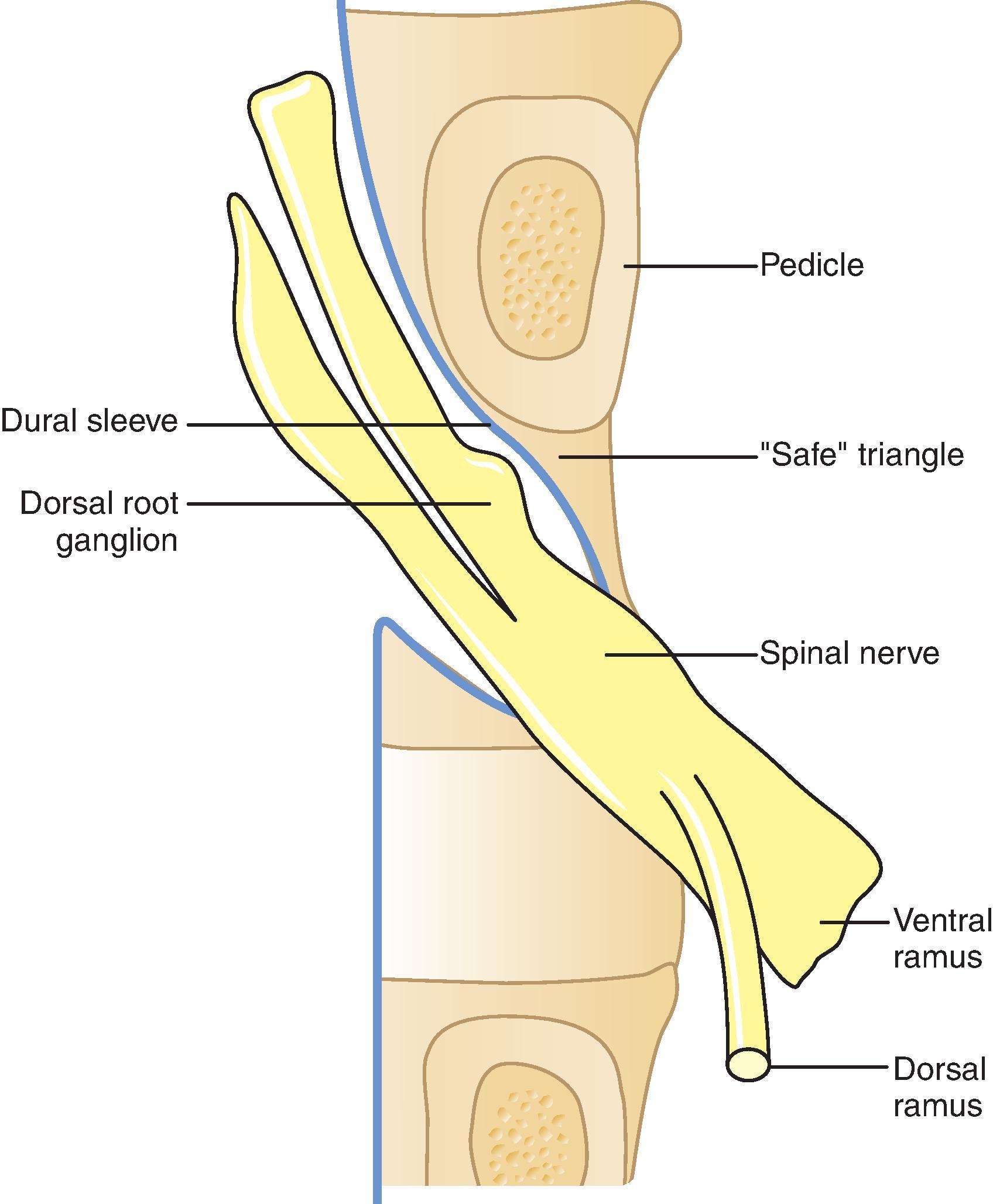 Figure 65.3, The “safe” triangle depicts the confines of the classic transforaminal epidural technique. The needle is safely placed inferior to the pedicle’s inferior border, superior to the tangentially exiting spinal nerve, and lateral to the dural sleeve.