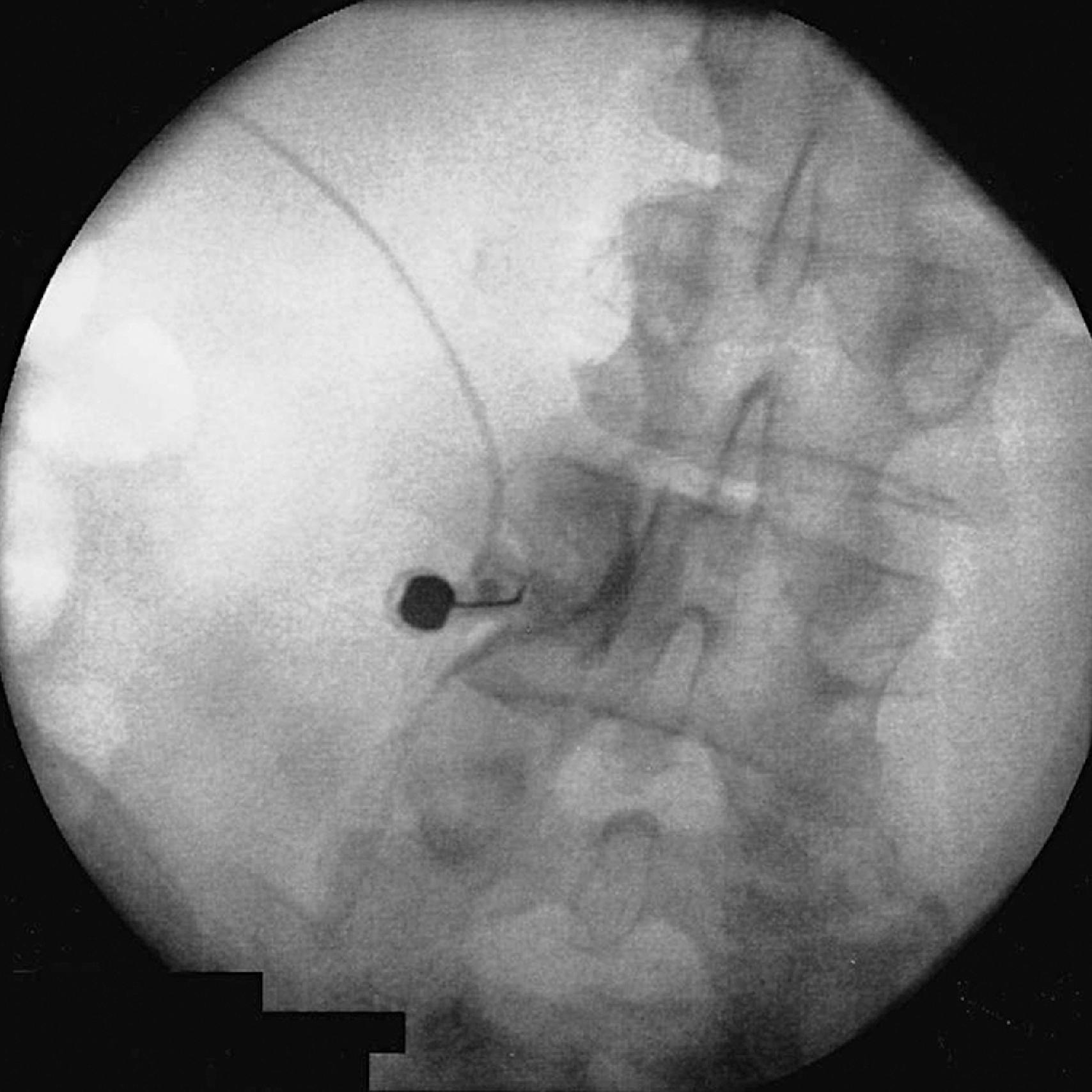 Figure 65.4, Spread of contrast dye is seen along the medial border of the pedicle and outlining the exiting spinal nerve.