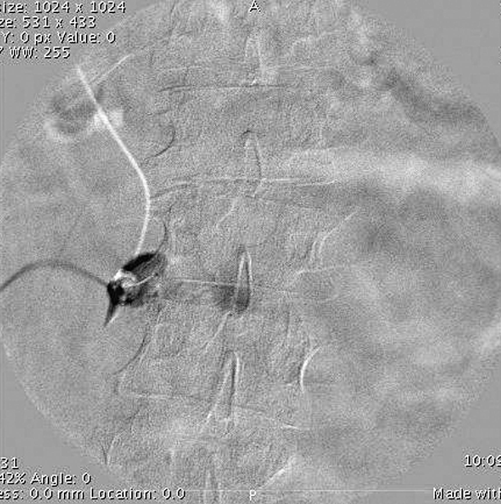 Figure 65.5, Digital subtraction sequence of a left L2 transforaminal epidural injection. The contrast dye outlines the exiting spinal nerve and displays no vascular uptake despite the high likelihood of proximity to the great segmental medullary artery of Adamkiewicz (see Figure 60.9).