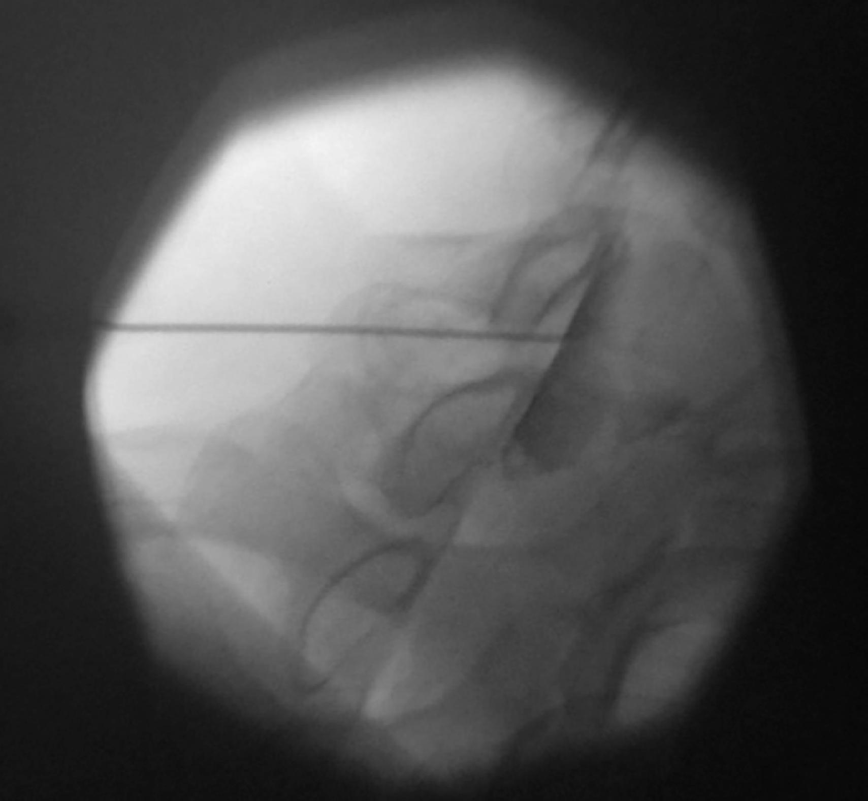 Figure 65.6, An interlaminar cervical epidural procedure demonstrates a characteristic filling pattern along the pedicular column in contralateral oblique fluoroscopic visualization.