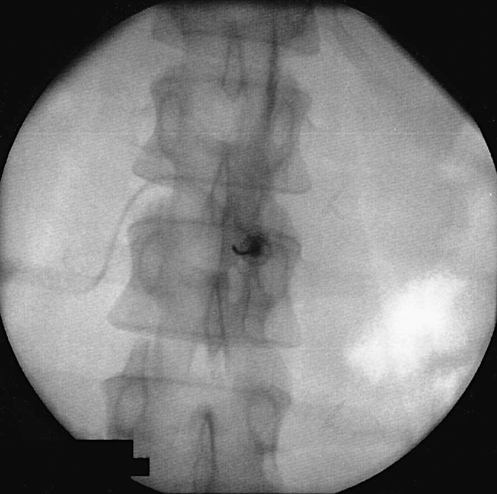 Figure 65.7, An interlaminar epidural procedure demonstrates one-sided spread at the same level and cephalad to the injection.