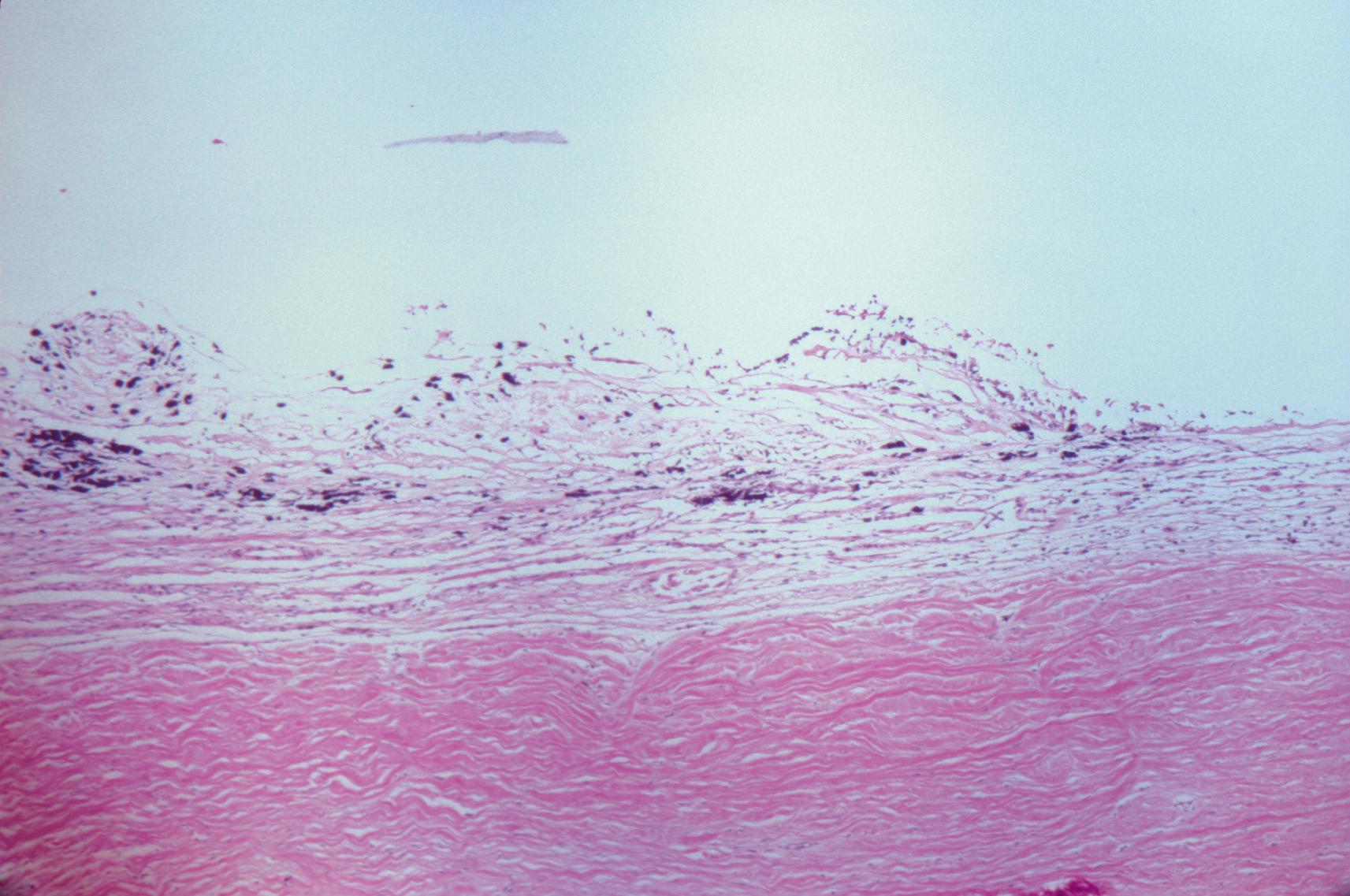 Fig. 22.2, Histopathologic section of snowbank in patient with intermediate uveitis of pars planitis subtype shows fibroglial cells, including fibrous astrocytes, on the surface of the peripheral retina and in the pars plana. Infiltrating inflammatory cells, predominantly lymphocytes, also can be seen. (Hematoxylin and eosin stain; original magnification ×50.)