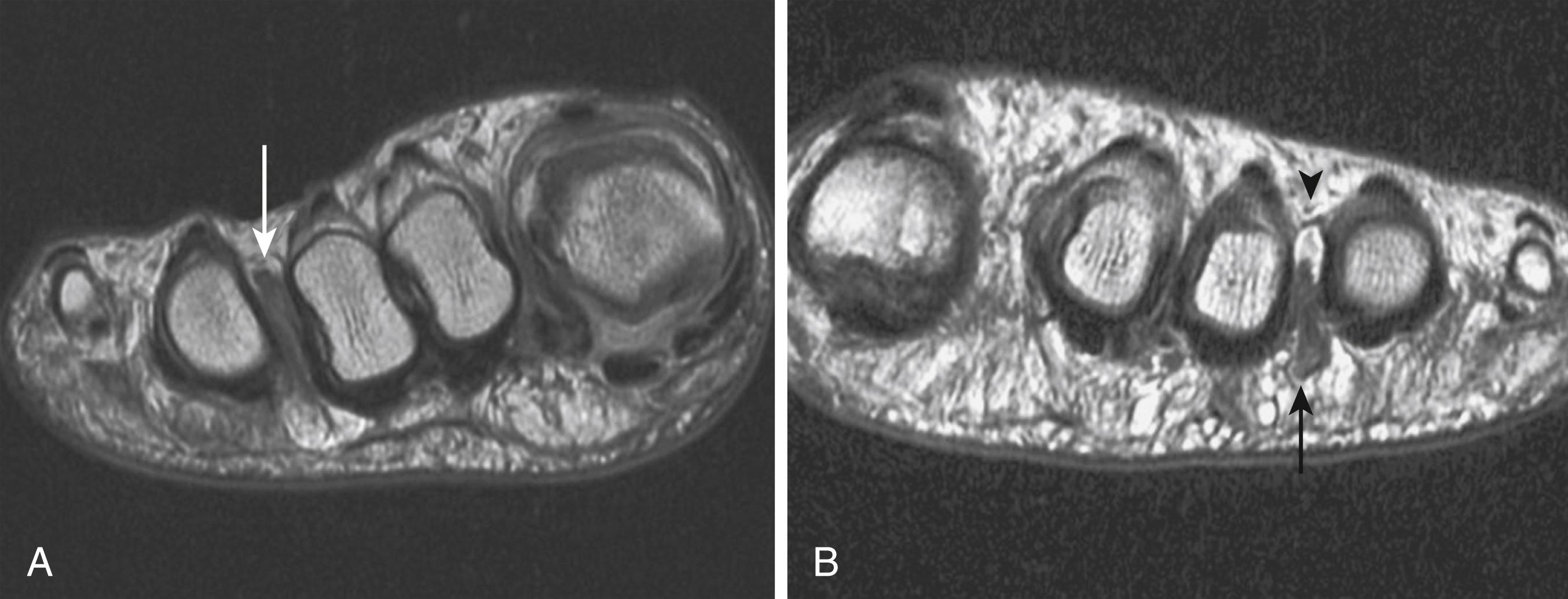 FIG. 198.1, Intermetatarsal bursitis and fibrosis. A, Coronal image of intermetatarsal fibrosis (arrow). B, Coronal image of third web space intermetatarsal bursitis (arrowhead) and fibrosis (arrow). Fibrous tissue prolapses to the plantar side of the web space.