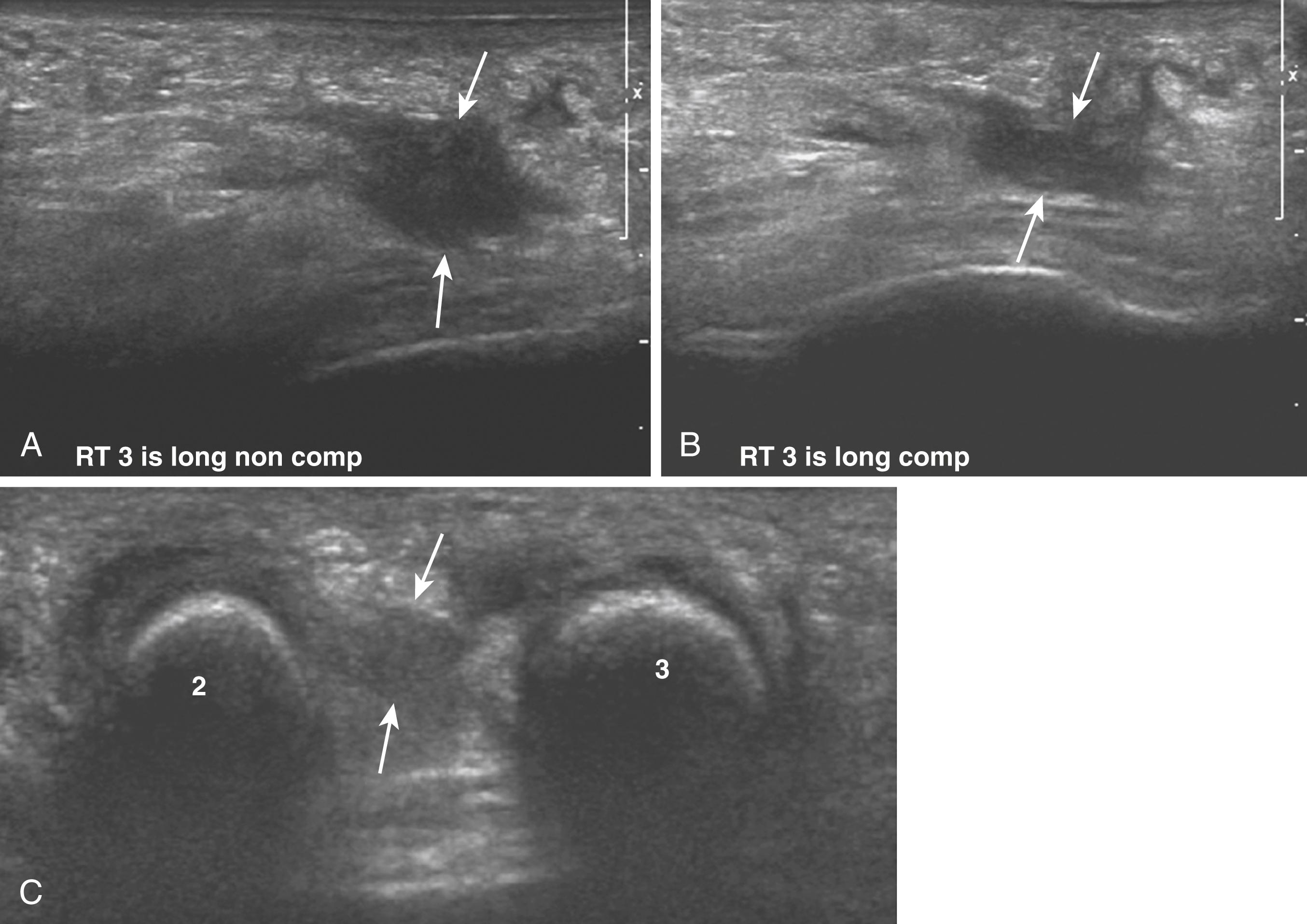FIG. 198.2, Morton neuroma with associated intermetatarsal bursitis. A and B, Longitudinal sonographic images and (C) transverse image of the third intermetatarsal space demonstrate a hypoechoic mass measuring 1.0 × 0.5 cm (arrows). The patient’s typical pain was produced during this examination. A, Noncompression image and (B) compression image show a change in configuration of the mass, representing coexisting bursitis. (C) Overestimation of the size of a Morton neuroma can occur with bursitis.