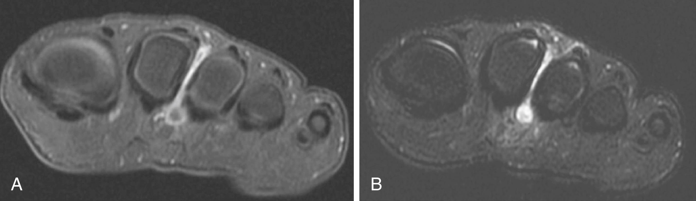 FIG. 198.3, Magnetic resonance imaging of the foot, in the short axis plane, T2-weighted (A) and T1-weighted with contrast (B), demonstrating a region of high signal intensity about the inferior aspect of the intermetatarsal space between the second and third metatarsals. This region exhibits a moderate degree of enhancement with the addition of contrast (B) caused by the presence of intermetatarsal bursitis.