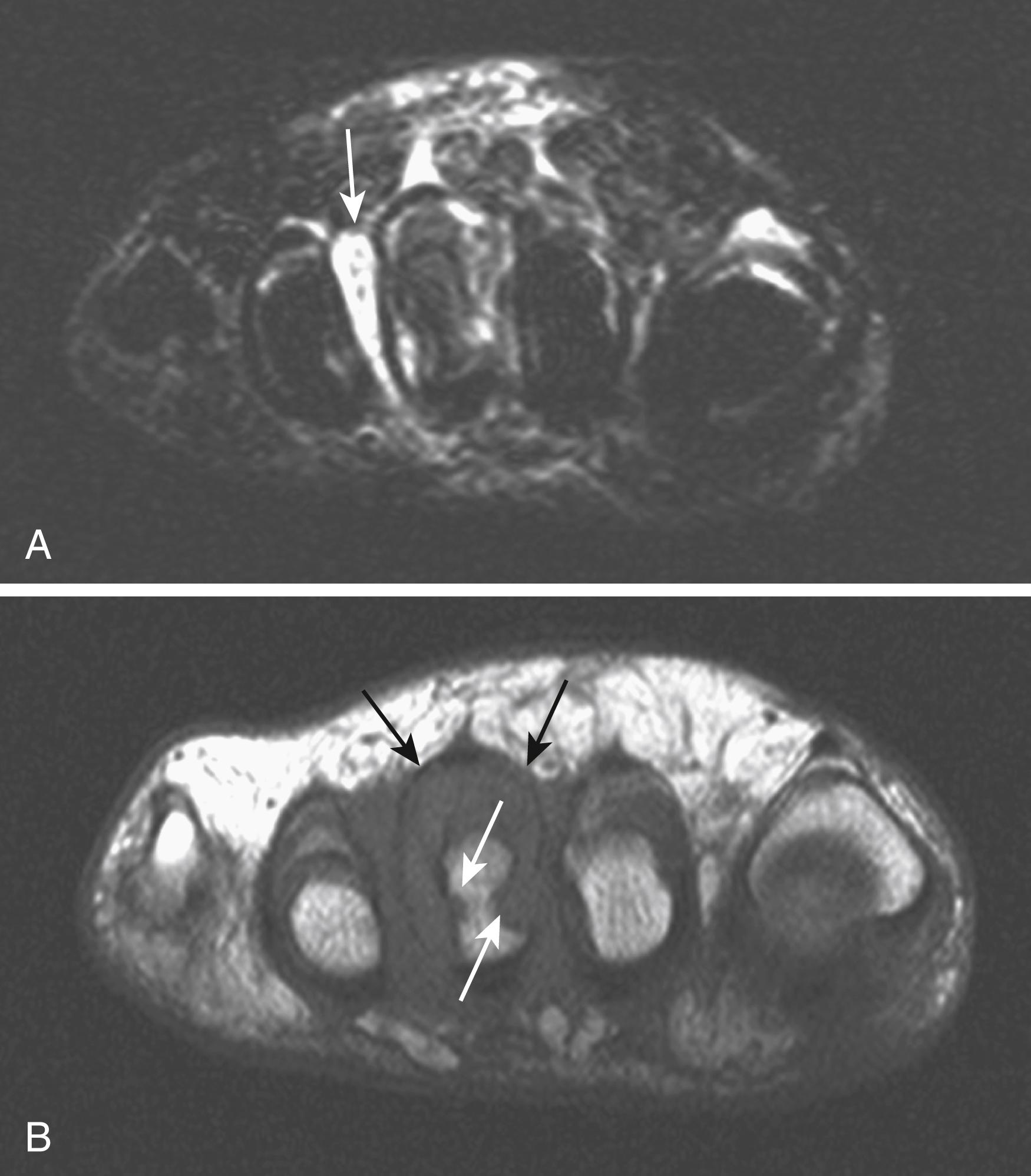 FIG. 198.4, A, Coronal T2-weighted magnetic resonance (MR) image of a patient with rheumatoid arthritis demonstrating an inflammatory bursa in the intermetatarsal space (white arrow). There is associated synovitis in the third metatarsophalangeal joint. B, The corresponding T1-weighted MR image shows the synovial thickening (black arrows) and the associated bony erosions (white arrows).