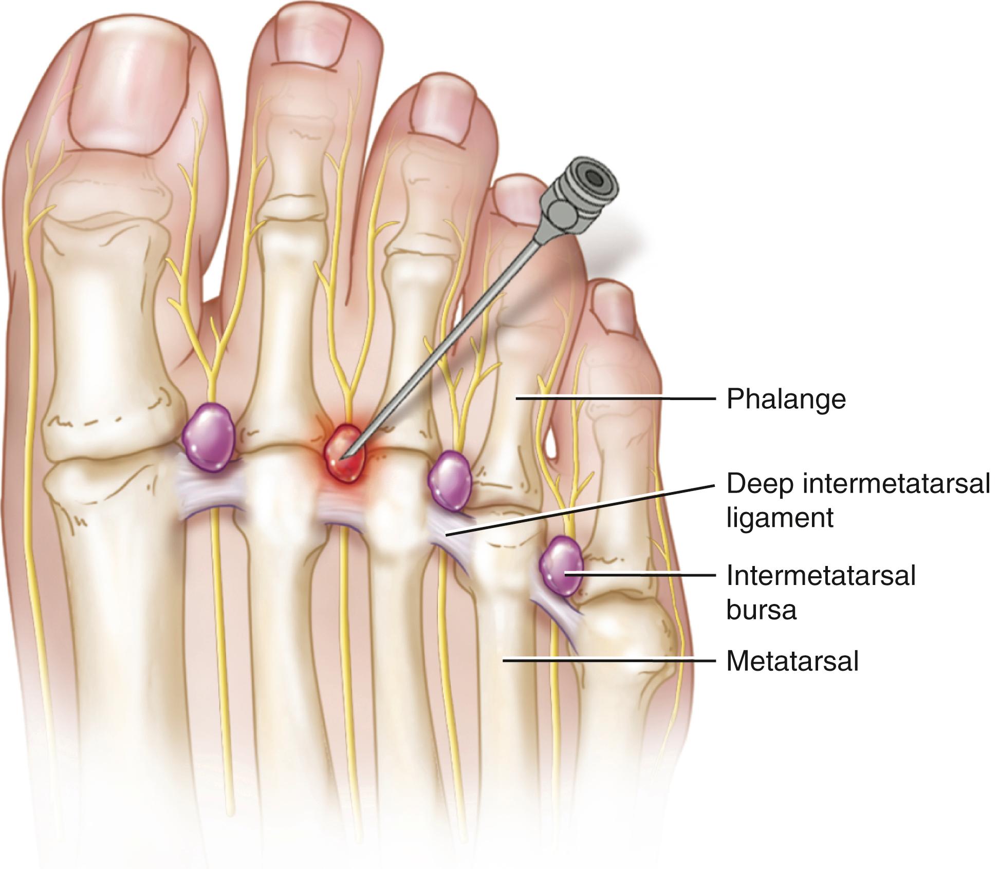 FIG. 198.5, Injection technique for treatment of intermetatarsal bursitis.