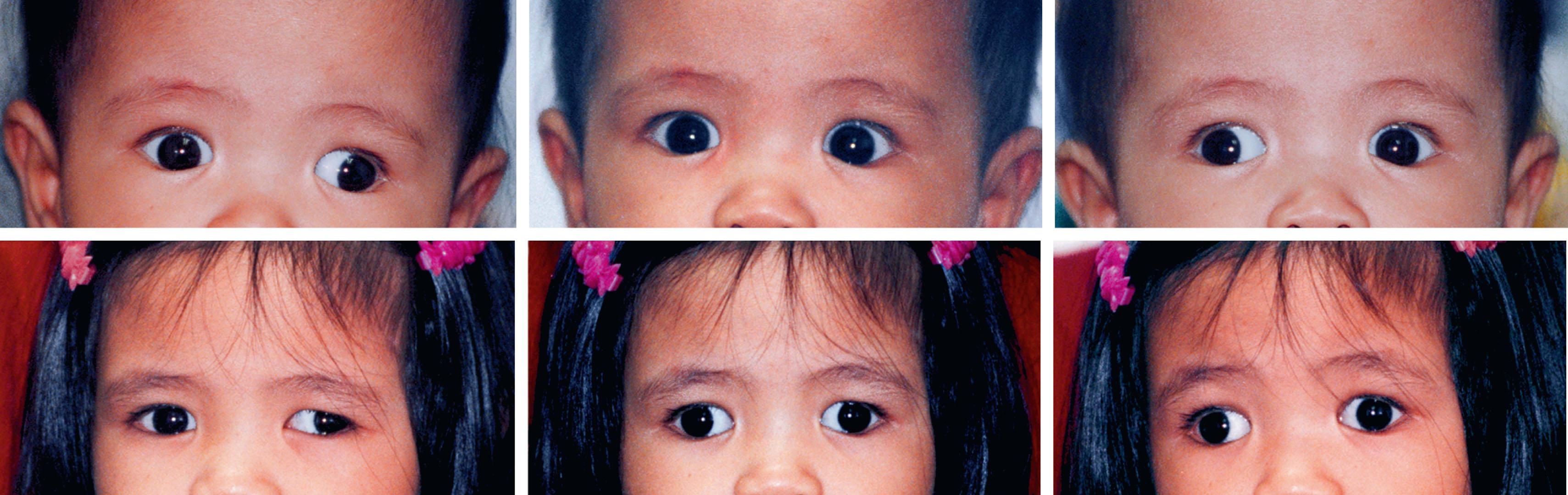 Fig. 80.1, A 7-month-old child with intermittent exotropia that progressed to constant exotropia. (Top center) At age 7 months, note orthotropia in primary gaze; (top left) large angle exotropia with right eye fixing; (top right) large angle exotropia with left eye fixing. Patient was initially managed conservatively with patching and convergence exercises with good control of the deviation after only 3 months. Patient failed to follow-up regularly. (Bottom) At the last evaluation at age 2 years, she had a large angle constant exotropia with left eye preference. Photos also show deviation with either eye fixing.