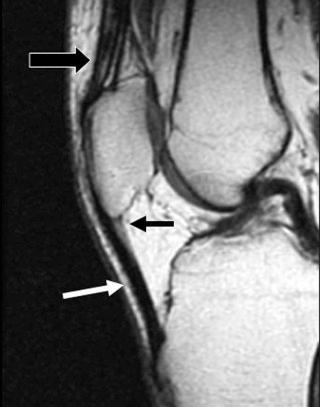 FIGURE 28–1, Normal quadriceps and patellar tendons. Sagittal, T1-weighted MR image shows the normal striated appearance of the quadriceps tendon (large black arrow) . The patellar tendon (white arrow) is straight and thinner than the quadriceps tendon, and its superficial and deep surfaces are parallel to each other. It is uniformly of low signal intensity except for a small triangle of intermediate signal intensity (small black arrow) along its proximal deep surface.