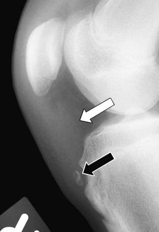 FIGURE 28–10, Osgood-Schlatter disease. Lateral radiograph shows heterotopic ossification (black arrow) in the distal aspect of the patellar tendon. The tendon is thickened. Ill-defined soft tissue density (white arrow) in Hoffa fat pad represents a distended infrapatellar bursa.