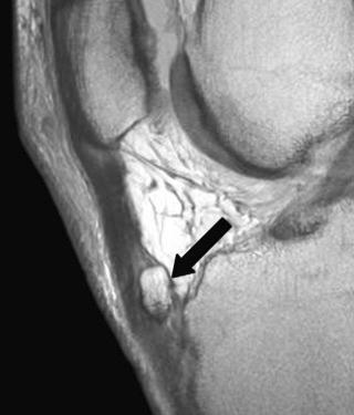 FIGURE 28–11, Osgood-Schlatter disease. Sagittal, proton density–weighted MR image shows thickening of the patellar tendon and focal heterotopic ossification (arrow) .