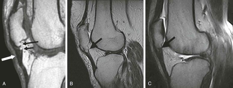 FIGURE 28–12, Sinding-Larsen-Johansson syndrome. A , Sagittal, T1-weighted MR image shows thickening of the proximal aspect of the patellar tendon (white arrow) , irregular ossification of the inferior pole of the patella (long black arrow) , and focal heterotopic ossification within the patellar tendon (short black arrow) . B, Sagittal, T2-weighted image shows patella baja and a focus of heterotopic ossification at the proximal aspect of the patellar tendon (arrow) . C, Sagittal T2-weighted image shows thickening of the proximal aspect of the patellar tendon with small focus of ossification.