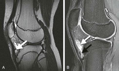 FIGURE 28–13, Osgood-Schlatter disease. A, Sagittal, T2-weighted image shows thickening of the patellar tendon and fragmentation of the tibial tubercle (arrow) . B, Sagittal short tau inversion recovery image shows intraligamentous ossicle and increased signal and thickening (black arrow) in the distal patellar tendon and a distended infrapatellar bursa (white arrow) .