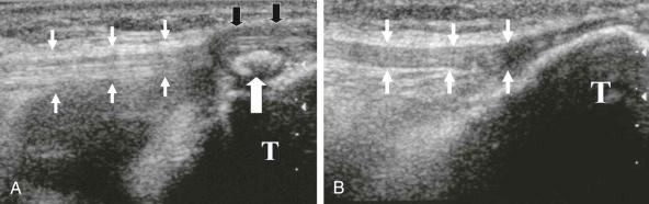FIGURE 28–14, Osgood-Schlatter disease. A , Longitudinal ultrasound image shows a normal-appearing midportion of the patellar tendon (small white arrows) . The distal aspect of the patellar tendon is thickened and hypoechoic (black arrows) with interstitial focal heterotopic ossification (large white arrow) . T, Tibia. B , Longitudinal ultrasound image of the contralateral normal knee shows a normal-appearing patellar tendon (white arrows) inserting on the tibia (T) .