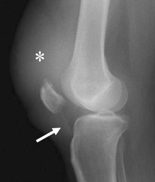 FIGURE 28–2, Quadriceps tendon rupture. Lateral radiograph shows marked suprapatellar soft tissue swelling (asterisk) . The patella shows abnormal anterior tilt away from the femoral condyles. The unaffected patellar tendon (white arrow) is normal.