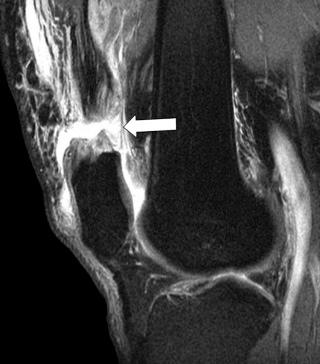 FIGURE 28–3, Quadriceps tendon rupture. Sagittal, fat-suppressed, T2-weighted MR image shows complete discontinuity of the distal aspect of the quadriceps tendon with edema within the tendon gap (arrow) . The proximal and distal torn ends of the tendon are heterogeneous and thickened, indicating underlying tendinosis. Edema evident by high signal intensity is present around the torn tendon edges.