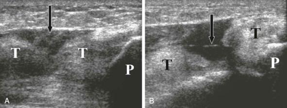 FIGURE 28–4, Quadriceps rupture. A , Longitudinal sonogram with knee in extension shows torn tendon edges (T) closely apposed to each other. There is a heterogeneously hypoechoic gap involving the anterior aspect of the tendon (arrow) . B , Longitudinal view of the same patient with the knee in flexion shows complete rupture and distraction of the tendon edges (T) with only a thin strand of tissue remaining (arrow) . The patella (P) is seen inferior to the tendon on both images.