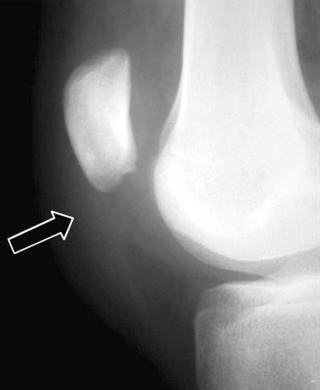 FIGURE 28–5, Patellar tendon rupture. Lateral radiograph shows loss of the normal shadow of the proximal aspect of the patellar tendon with surrounding soft tissue edema (arrow) . The patella is high riding due to the unopposed pull of the quadriceps muscle.