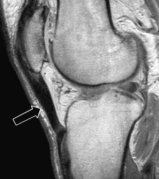 FIGURE 28–6, Patellar tendinosis. Sagittal, proton density–weighted MR image shows a markedly thickened patellar tendon (arrow) with heterogeneous internal signal both proximally and distally.