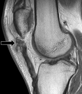 eFIGURE 28–1, Patellar tendinosis. Sagittal, proton density–weighted MR image shows rupture of the proximal aspect of the patellar tendon, which has balled up on itself (arrow) but with only minimal retraction. The tendon shows diffuse degeneration manifested by thickening and signal heterogeneity. There is similar tendinosis in the visualized portion of the distal quadriceps tendon.