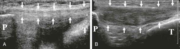 FIGURE 28–7, Patellar tendinosis. A , Longitudinal sonogram of a normal patellar tendon shows an echogenic fibrillar appearance with superficial and deep surfaces (white arrows) that are parallel to each other. B , Longitudinal sonogram of the patellar tendon shows marked thickening. The superficial and deep surfaces (white arrows) are not parallel, and the tendon has a heterogeneous echotexture. The patella (P) is seen superiorly, and the proximal tibia (T) is seen inferiorly.