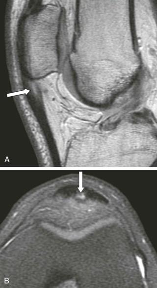 FIGURE 28–8, Jumper's knee. A , Sagittal, proton density–weighted MR image shows fusiform swelling of the proximal aspect of the patellar tendon and internal high signal intensity (arrow) . B , Axial, fat-suppressed, T2-weighted MR image in the same patient shows the high–signal-intensity focus involving the deep aspect of the central third of the tendon.