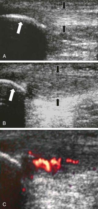 FIGURE 28–9, Jumper's knee. A , Longitudinal sonogram of a normal patellar tendon shows the normal fibrillar echogenic appearance of the tendon with parallel superficial and deep surfaces (black arrows) . The inferior pole of the patella is seen (white arrow) . B , Longitudinal ultrasound image of a different patient shows fusiform swelling of the proximal aspect of the patellar tendon ( black arrows ). The inferior pole of the patella is seen (white arrow) . C , Power Doppler image of the same patient as in B shows marked interstitial hyperemia representing angiofibroblastic proliferation.