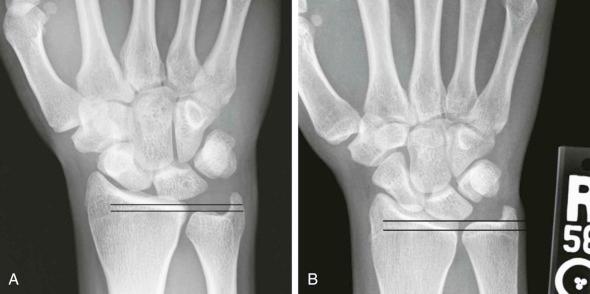 Internal Derangement of the Wrist - Clinical Tree