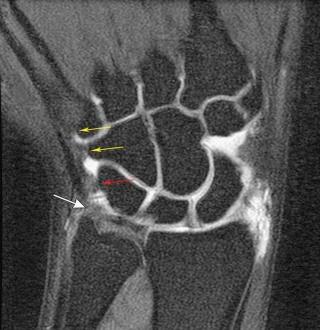 Internal Derangement of the Wrist - Clinical Tree