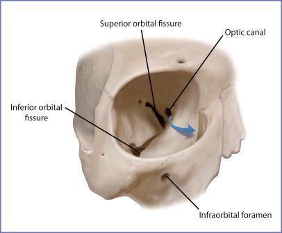 Fig. 7.2, Orbit with its constituent bones and communications. Note convex shape (blue arrow) of inferomedial aspect of internal orbit.