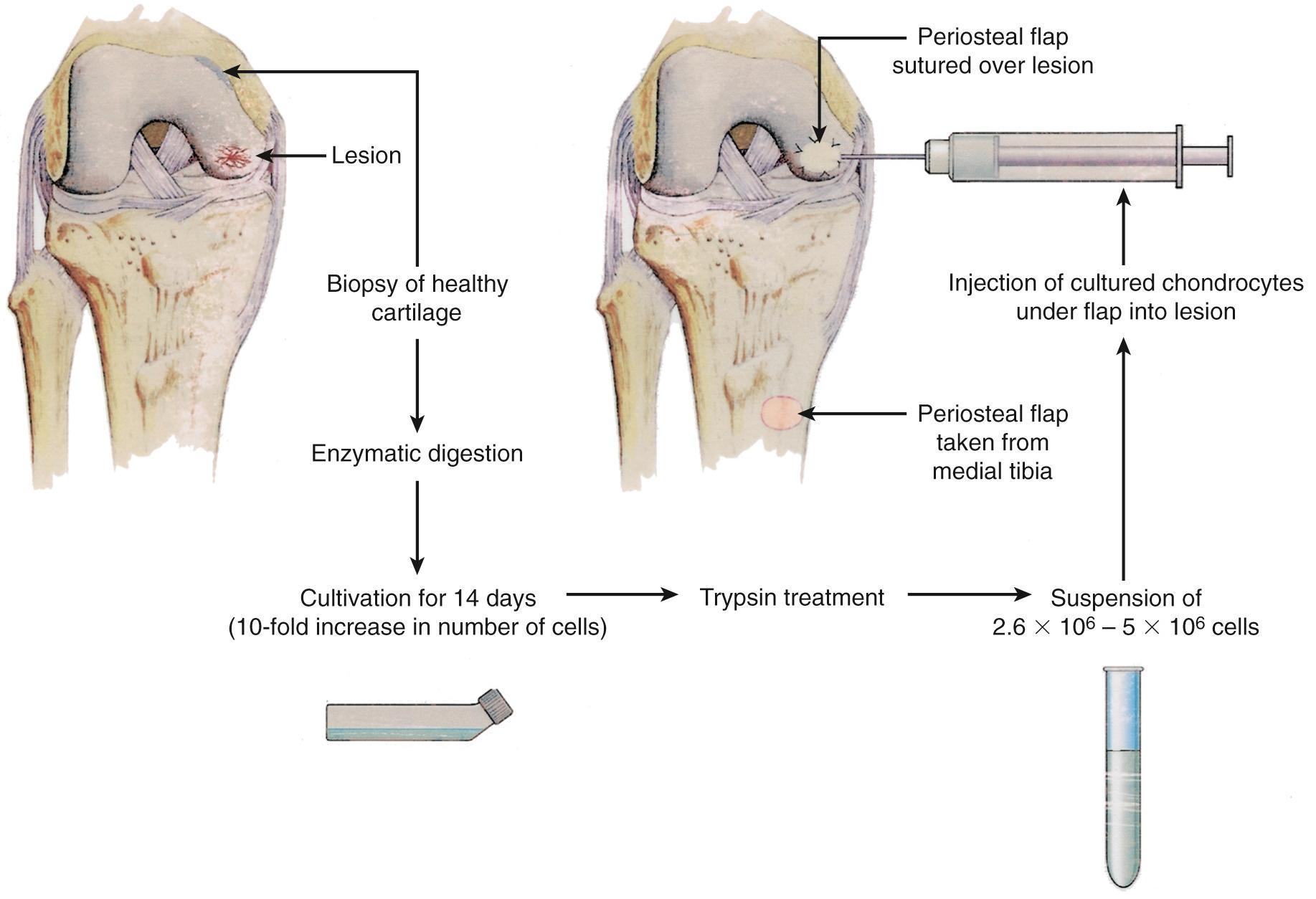 FIG 29.1, Diagram of the autologous chondrocyte implantation procedure.