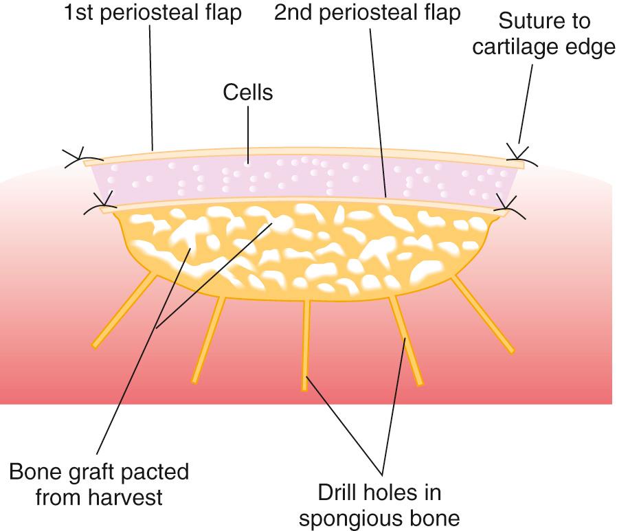 FIG 29.11, Schematic drawing of the sandwich procedure with layers of transplanted bone, periosteal flap, chondrocytes, and periosteal flap.