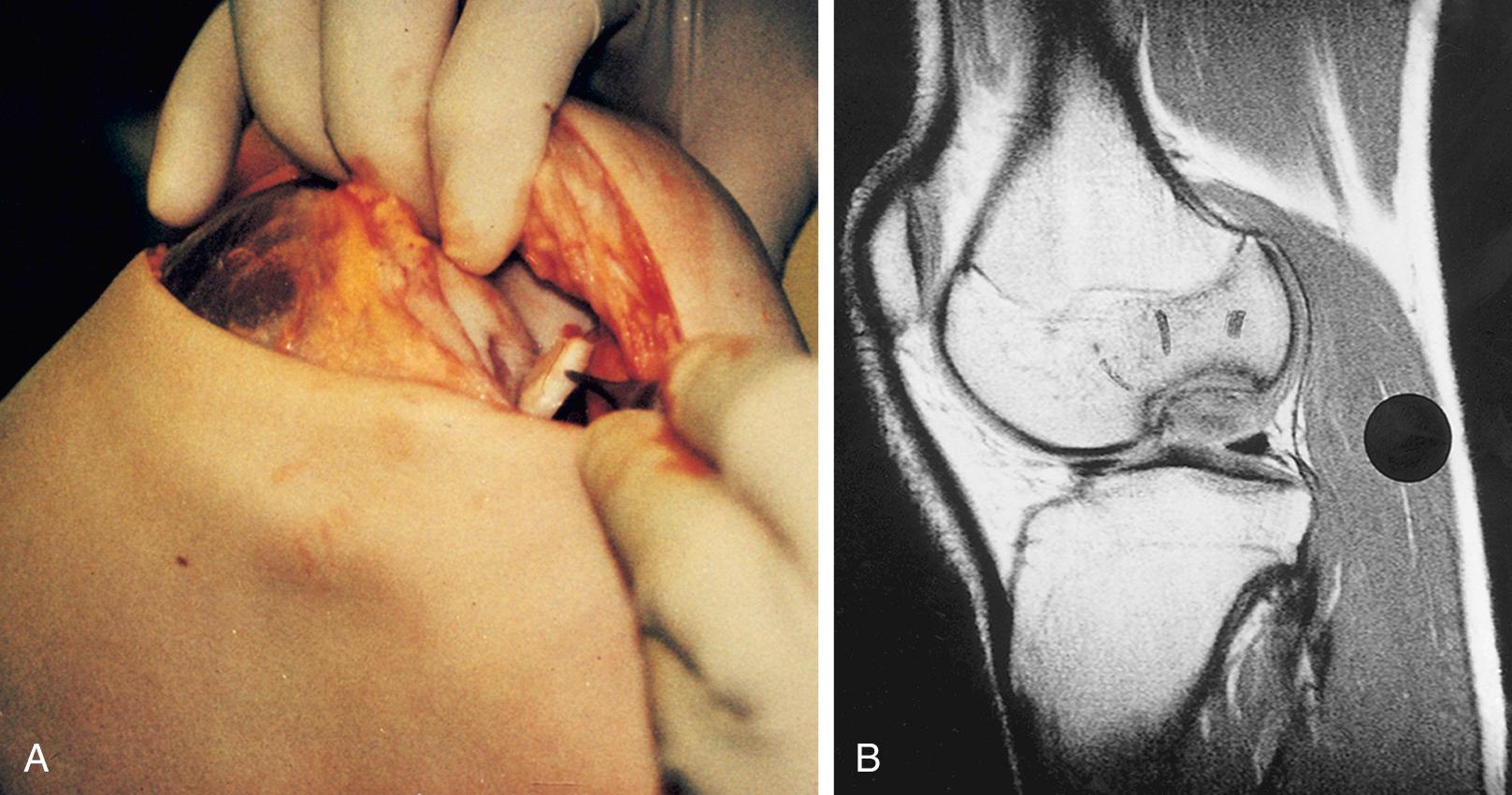 FIG 29.3, (A) Arthrotomy of a right knee with osteochondritis dissecans of the lateral femoral condyle and an avulsed but attached flap, an indication for autologous chondrocyte implantation. (B) Magnetic resonance image showing a deep osseous defect on the lateral femoral condyle.