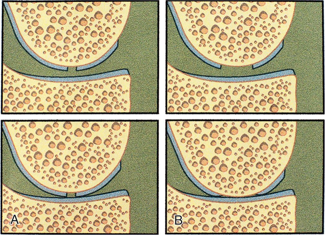 FIG 29.5, (A) Shouldered defects are usually smaller than 10 mm and are contained. (B) Unshouldered defects are larger. During weight bearing, the center of the defect is in contact with the opposing articular surface.