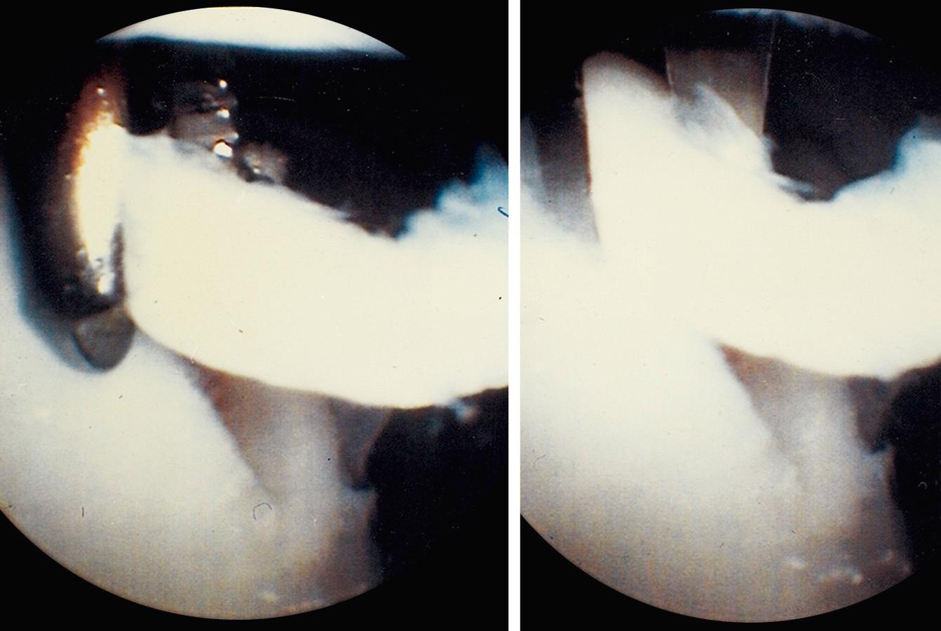 FIG 29.6, Arthroscopic views showing harvesting of articular cartilage from the upper medial femoral condyle with a curette ( right ).