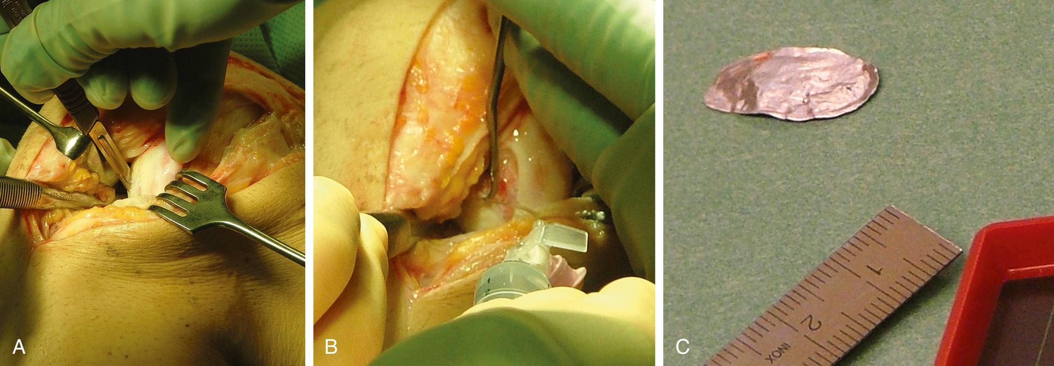 FIG 29.8, All damaged or undermined cartilage is excised (A) and carefully débrided (B). A template of the defect is made from sterile aluminum foil (C).