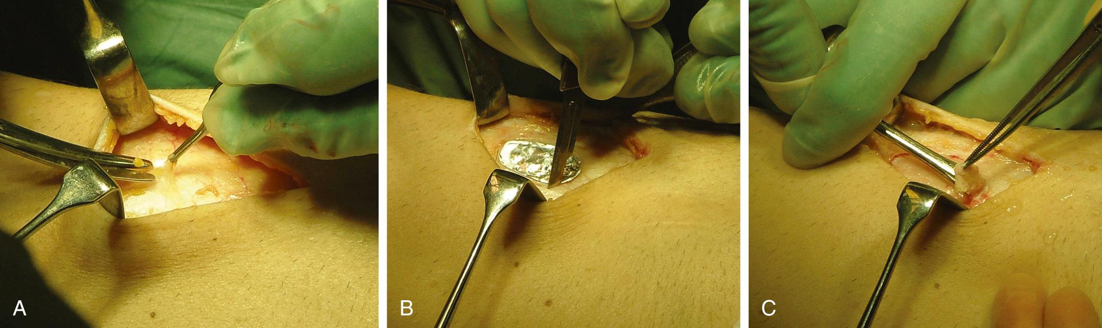 FIG 29.9, (A) Careful dissection to get access to good-quality periosteum. (B) The template is used for determining the correct size and form of the periosteal flap. (C) With careful technique the flap is removed.